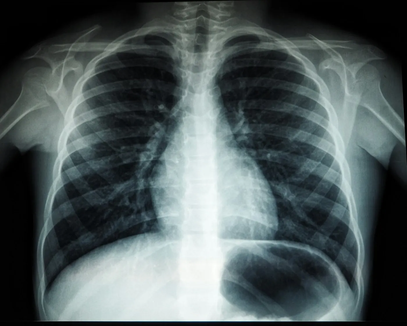 Radiografia de tórax em negatoscópio, mostrando arcos costais e campos pulmonares
